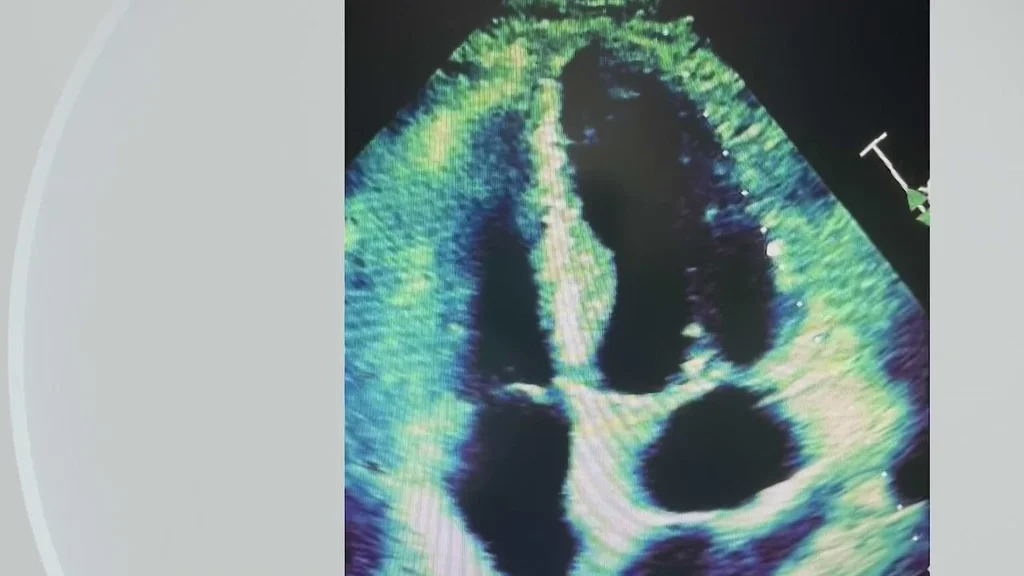 South Florida man spent decades not knowing he had extremely rare heart defect